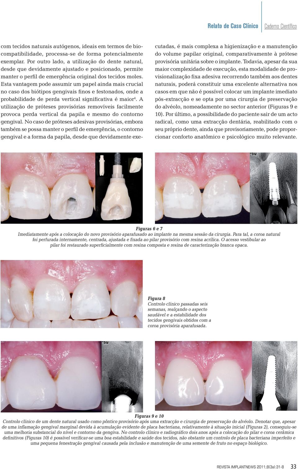 Esta vantagem pode assumir um papel ainda mais crucial no caso dos biótipos gengivais finos e festonados, onde a probabilidade de perda vertical significativa é maior 4.