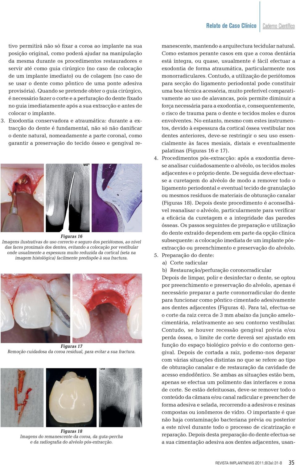 Figuras 18 Imagens do remanescente da coroa, da guta-percha e da radiografia do alvéolo pós-extracção.