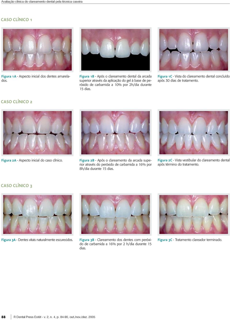 Figura 1C - Vista do clareamento dental concluído após 30 dias de tratamento. caso clínico 2 Figura 2A - Aspecto inicial do caso clínico.