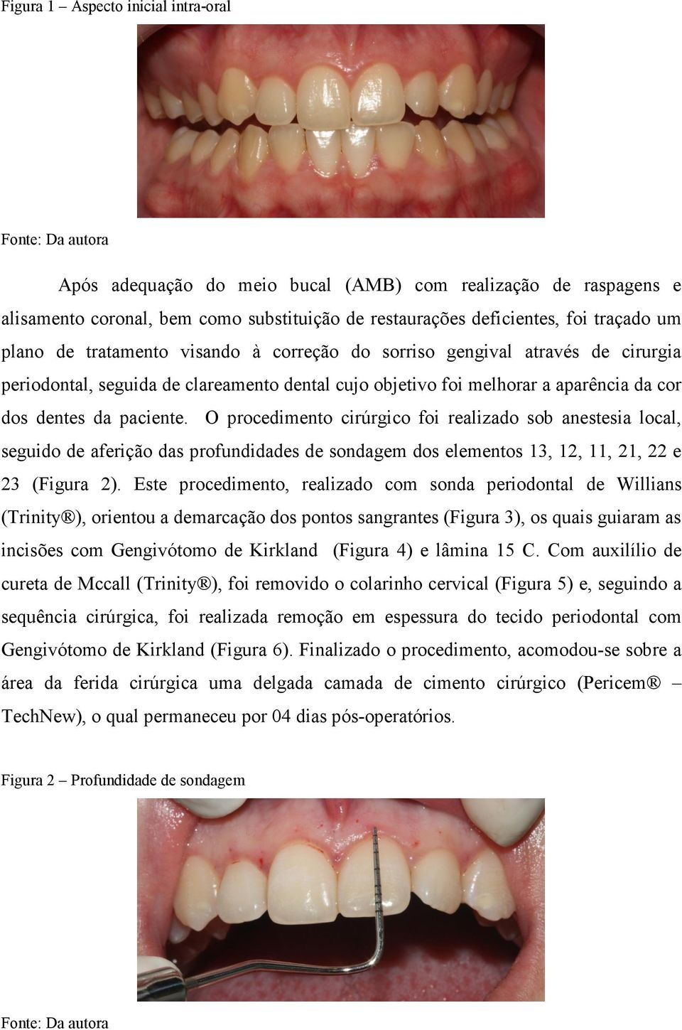 O procedimento cirúrgico foi realizado sob anestesia local, seguido de aferição das profundidades de sondagem dos elementos 13, 12, 11, 21, 22 e 23 (Figura 2).