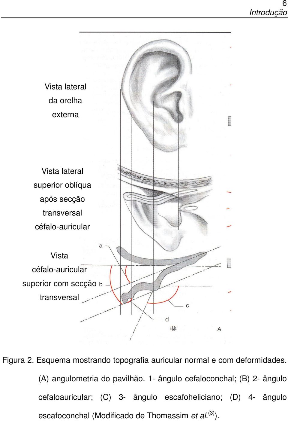 Esquema mostrando topografia auricular normal e com deformidades. (A) angulometria do pavilhão.