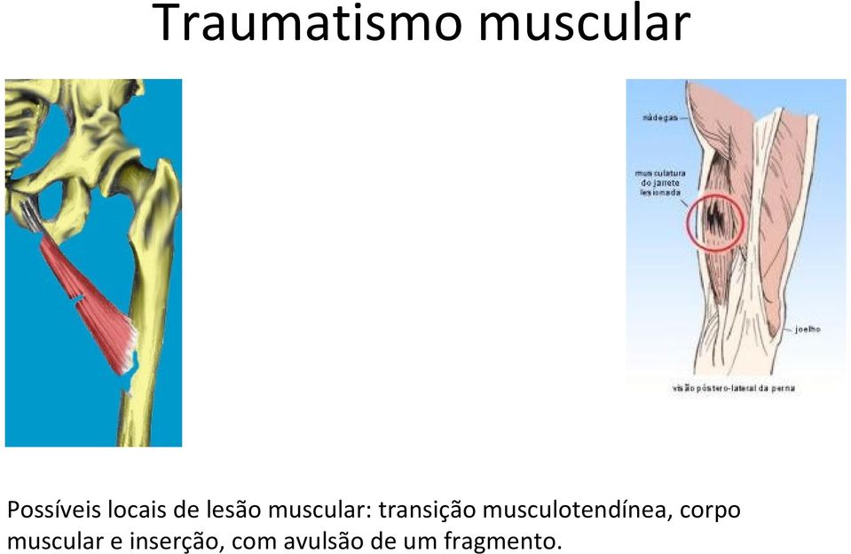 transição musculotendínea, corpo