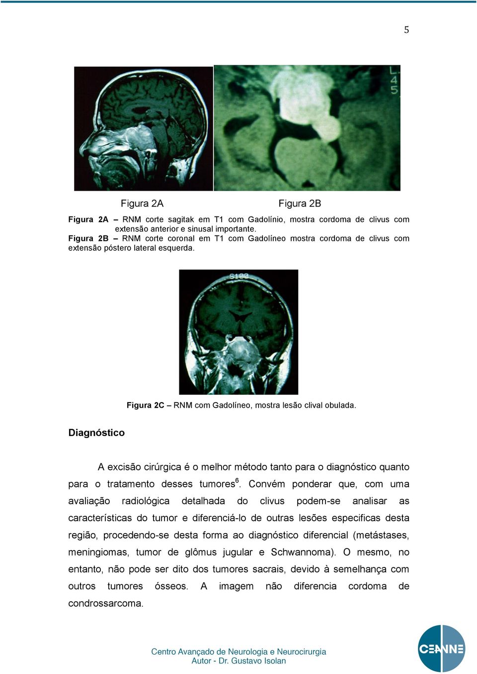 Diagnóstico A excisão cirúrgica é o melhor método tanto para o diagnóstico quanto para o tratamento desses tumores 6.