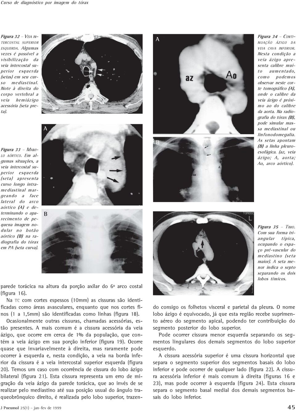 Em algumas situações, a veia intercostal superior esquerda (seta) apresenta curso longo intramediastinal margeando a face lateral do arco aórtico () e determinando o aparecimento de pequena imagem