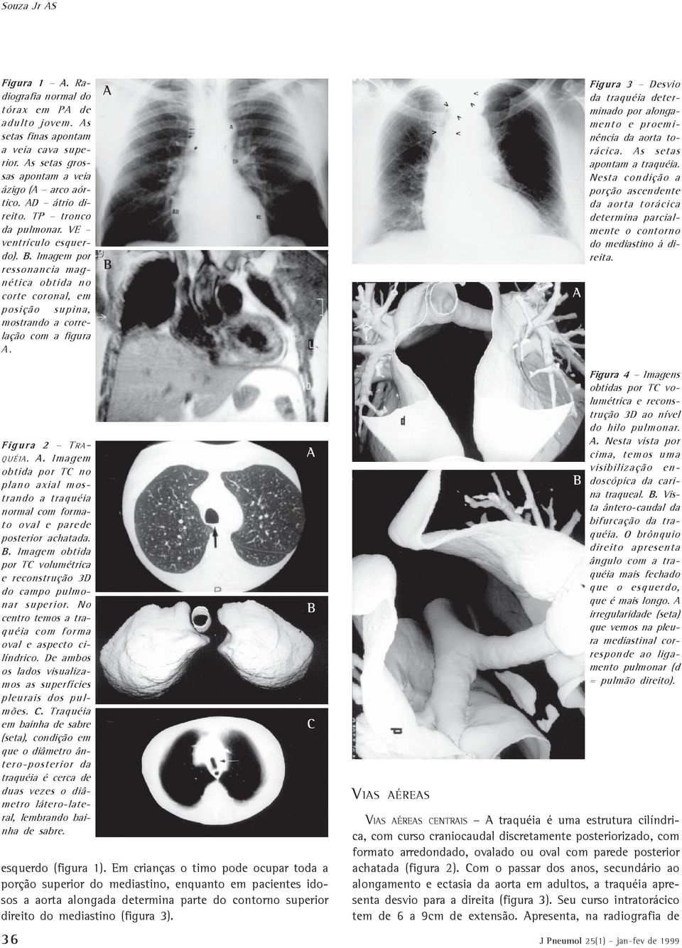 Figura 3 Desvio da traquéia determinado por alongamento e proeminência da aorta torácica. s setas apontam a traquéia.