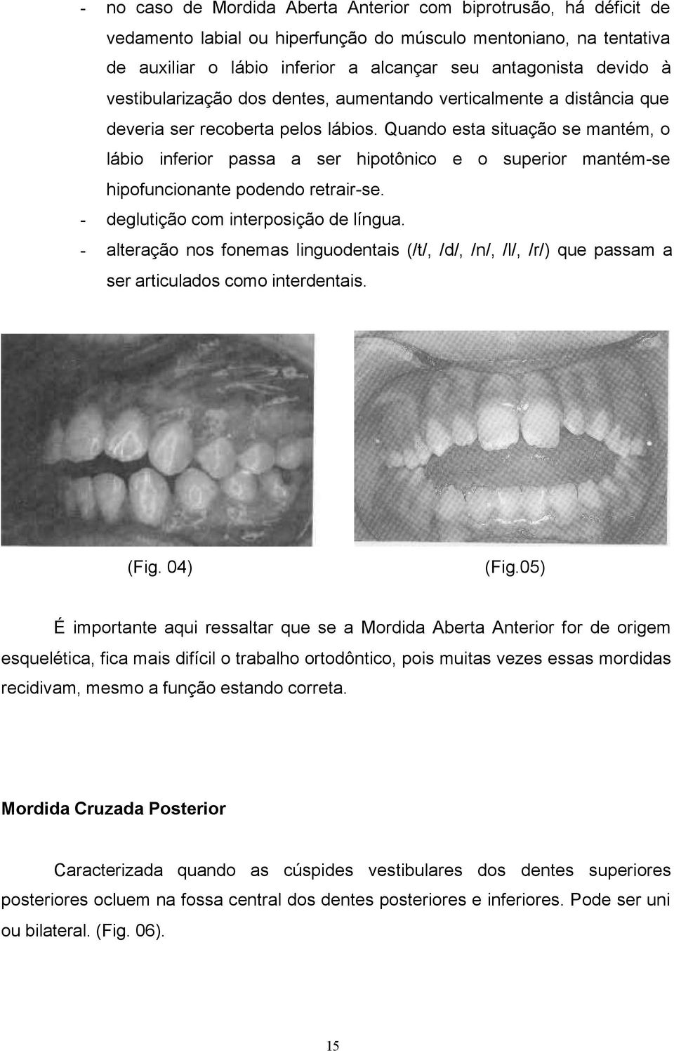 Quando esta situação se mantém, o lábio inferior passa a ser hipotônico e o superior mantém-se hipofuncionante podendo retrair-se. - deglutição com interposição de língua.