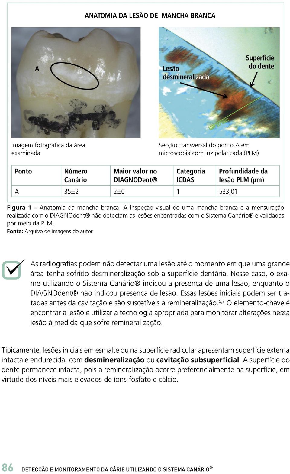 A inspeção visual de uma mancha branca e a mensuração realizada com o DIAGNOdent não detectam as lesões encontradas com o Sistema Canário e validadas por meio da PLM.