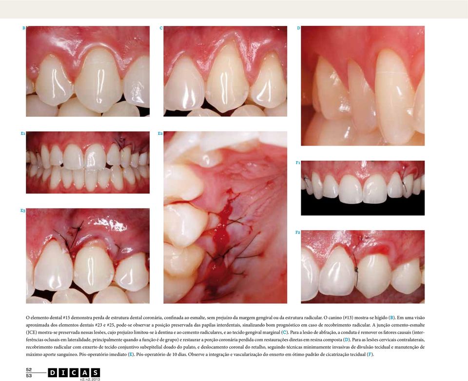 Em uma visão aproximada dos elementos dentais #23 e #25, pode-se observar a posição preservada das papilas interdentais, sinalizando bom prognóstico em caso de recobrimento radicular.
