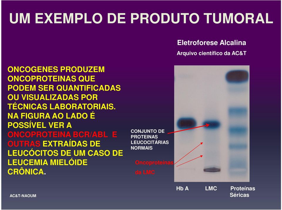 NA FIGURA AO LADO É POSSÍVEL VER A ONCOPROTEINA BCR/ABL E OUTRAS EXTRAÍDAS DE LEUCÓCITOS DE UM CASO