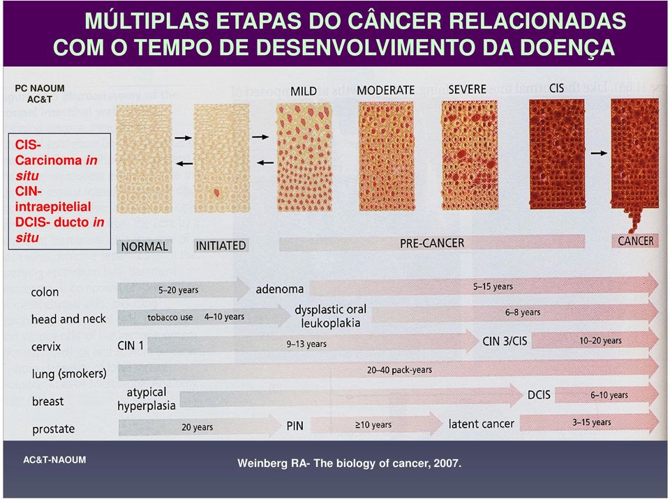 CIS- Carcinoma in situ CINintraepitelial DCIS-