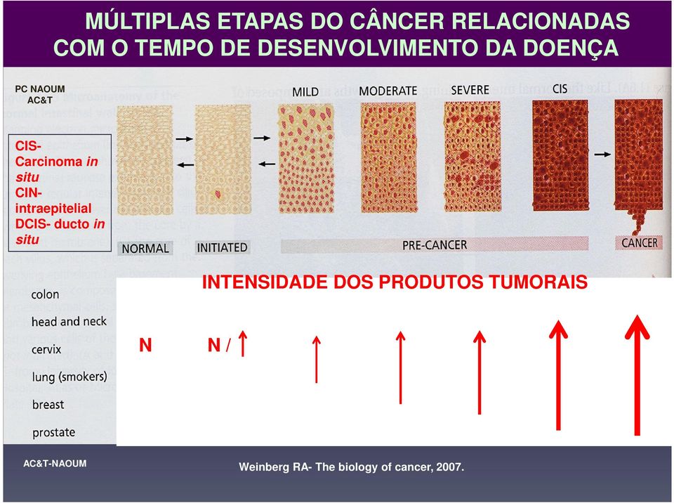 situ CINintraepitelial DCIS- ducto in situ INTENSIDADE DOS