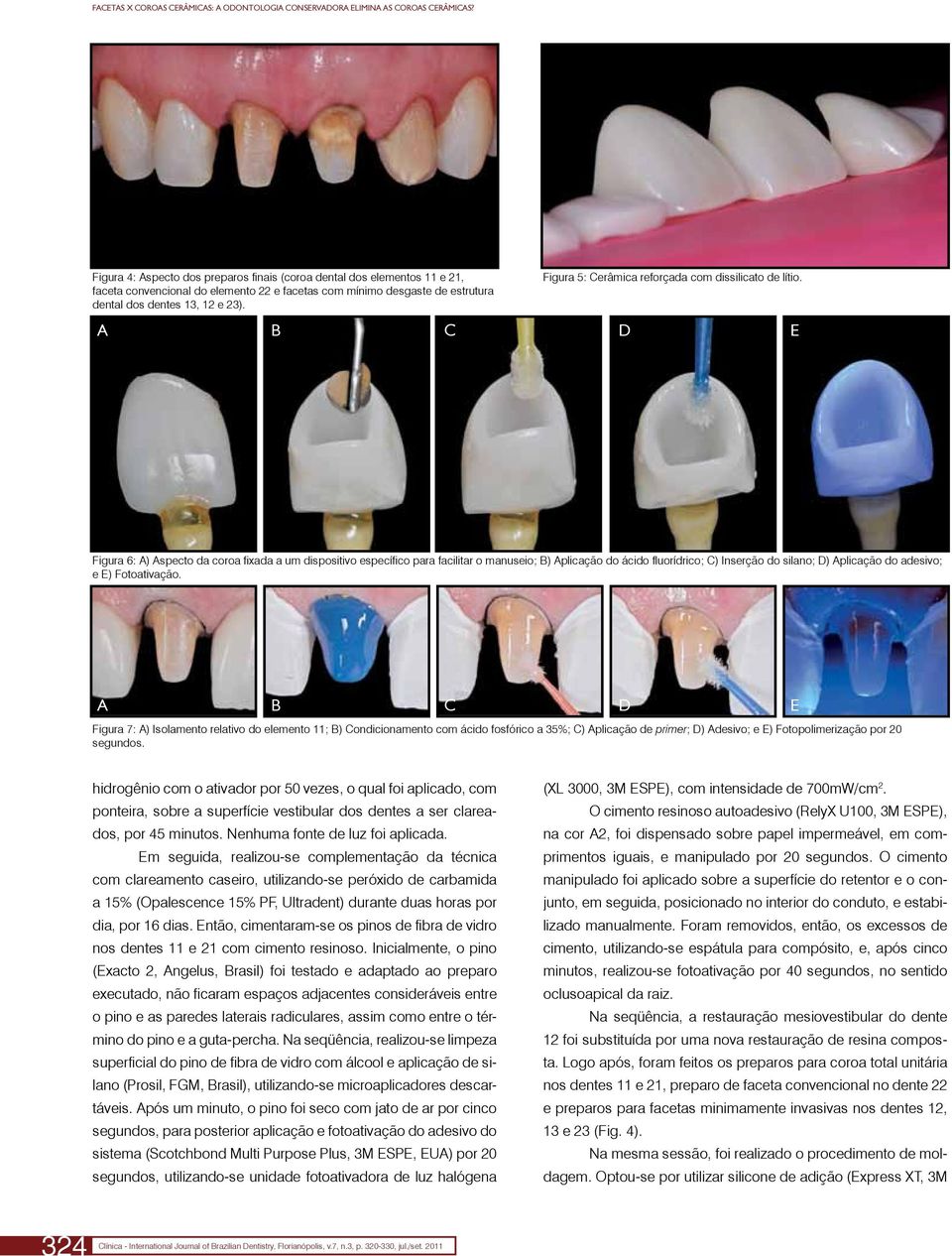 D E Figura 6: A) Aspecto da coroa fixada a um dispositivo específico para facilitar o manuseio; B) Aplicação do ácido fluorídrico; C) Inserção do silano; D) Aplicação do adesivo; e E) Fotoativação.