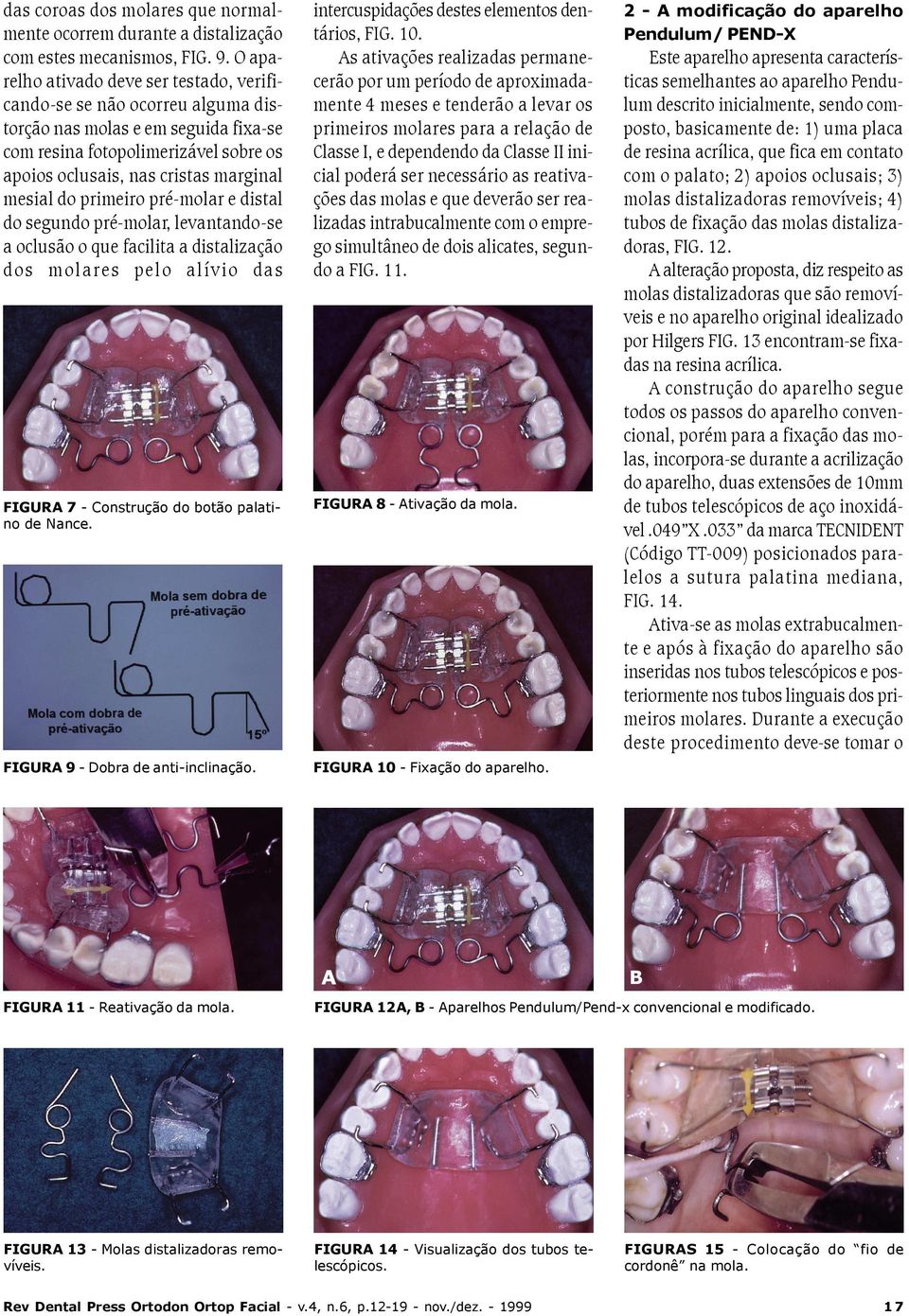 do primeiro pré-molar e distal do segundo pré-molar, levantando-se a oclusão o que facilita a distalização dos molares pelo alívio das FIGURA 7 - Construção do botão palatino de Nance.