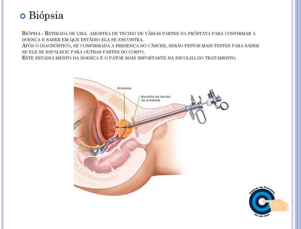 APÓS O DIAGNÓSTICO, SE CONFIRMADA A PRESENÇA DO CÂNCER, SERÃO FEITOS MAIS TESTES PARA SABER