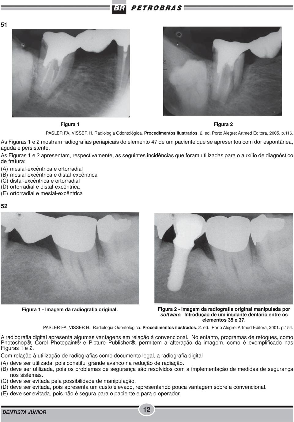 As Figuras 1 e 2 apresentam, respectivamente, as seguintes incidências que foram utilizadas para o auxílio de diagnóstico de fratura: (A) mesial-excêntrica e ortorradial (B) mesial-excêntrica e