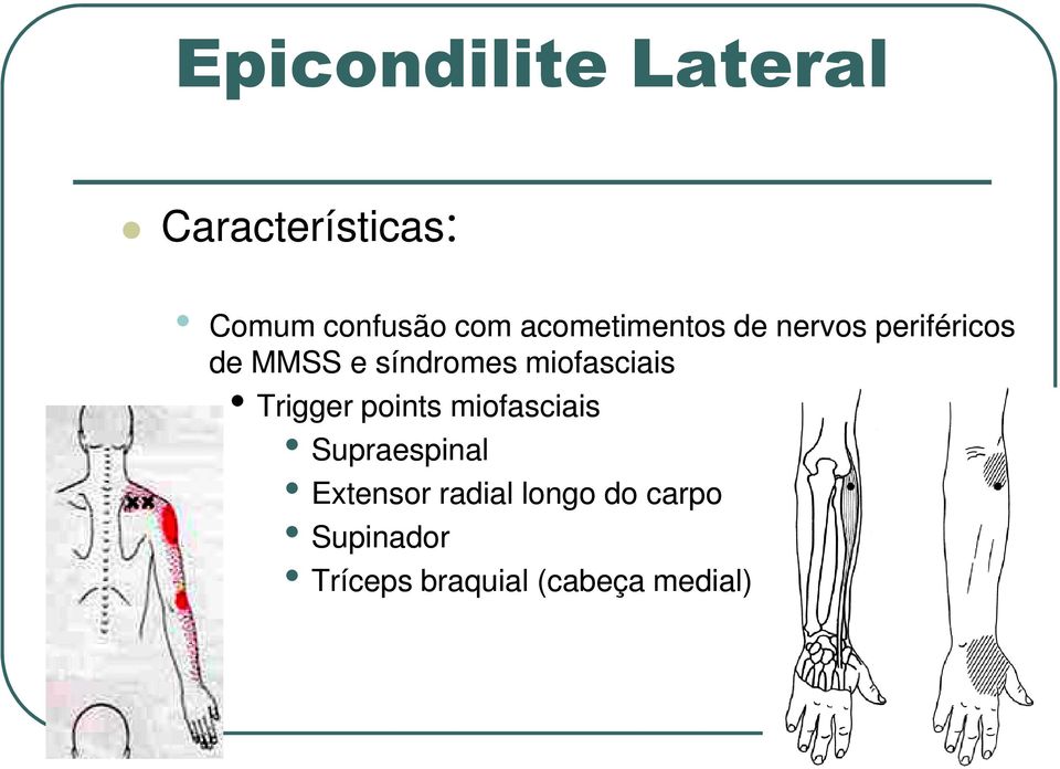 miofasciais Trigger points miofasciais Supraespinal