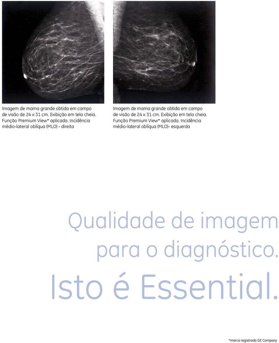 Incidência médio-lateral oblíqua (MLO) - direita   Incidência médio-lateral oblíqua (MLO)- esquerda