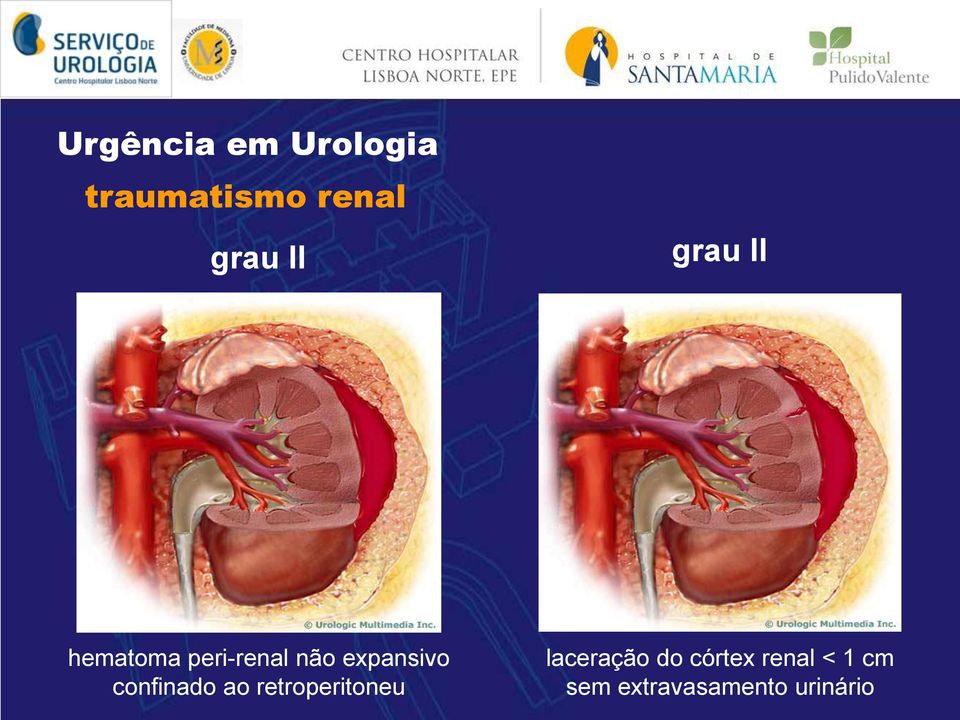 confinado ao retroperitoneu laceração