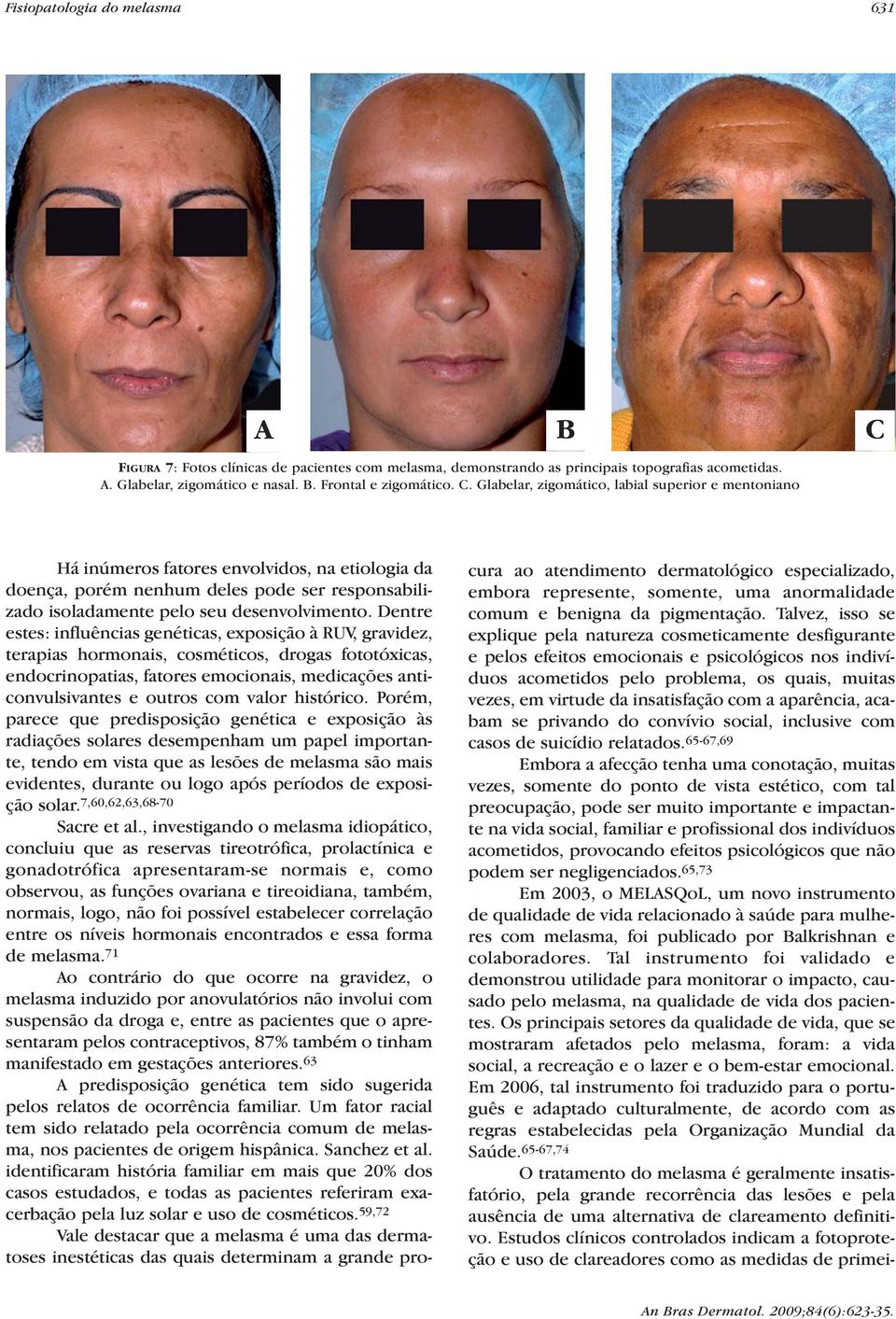 Glabelar, zigomático, labial superior e mentoniano Há inúmeros fatores envolvidos, na etiologia da doença, porém nenhum deles pode ser responsabilizado isoladamente pelo seu desenvolvimento.