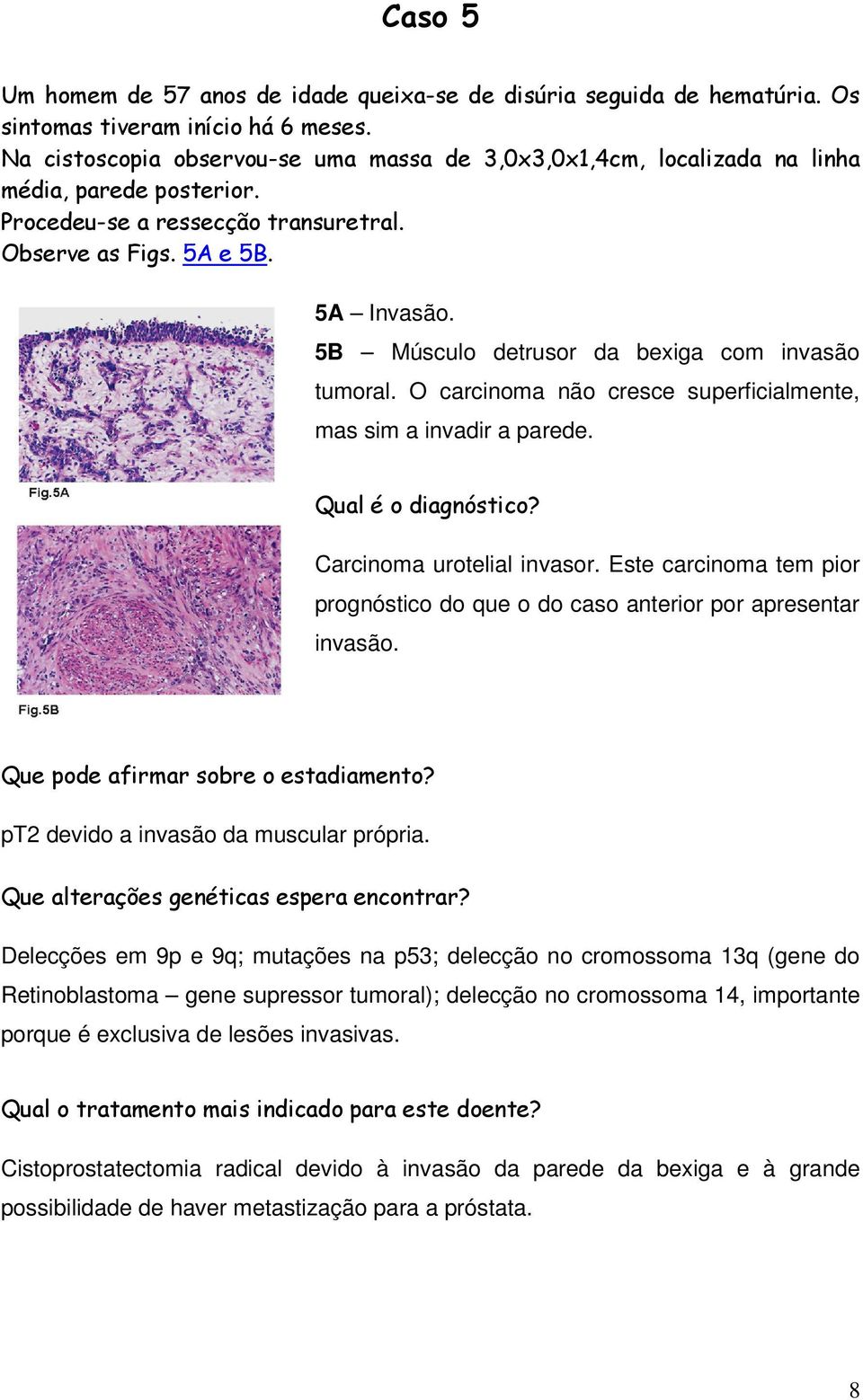 5B Músculo detrusor da bexiga com invasão tumoral. O carcinoma não cresce superficialmente, mas sim a invadir a parede. Qual é o diagnóstico? Carcinoma urotelial invasor.