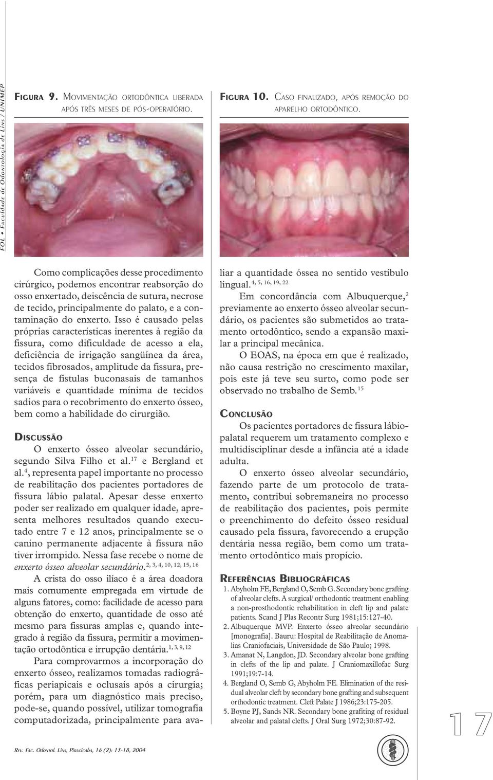 Isso é causado pelas próprias características inerentes à região da fissura, como dificuldade de acesso a ela, deficiência de irrigação sangüínea da área, tecidos fibrosados, amplitude da fissura,