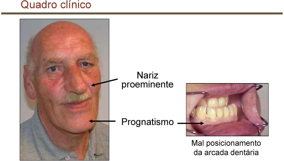 Prognatismo Mal