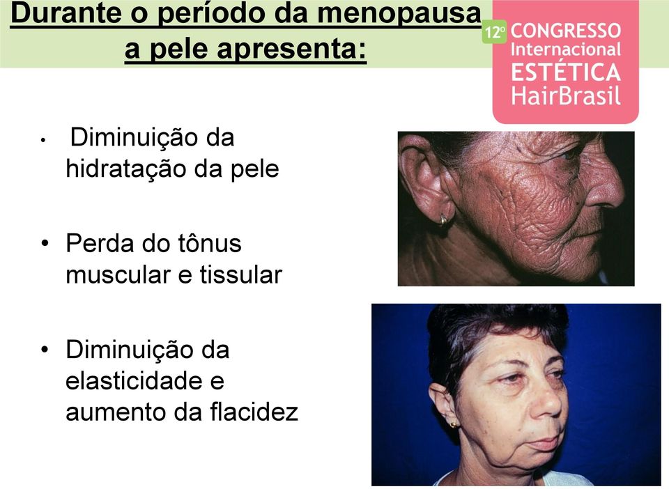 pele Perda do tônus muscular e tissular