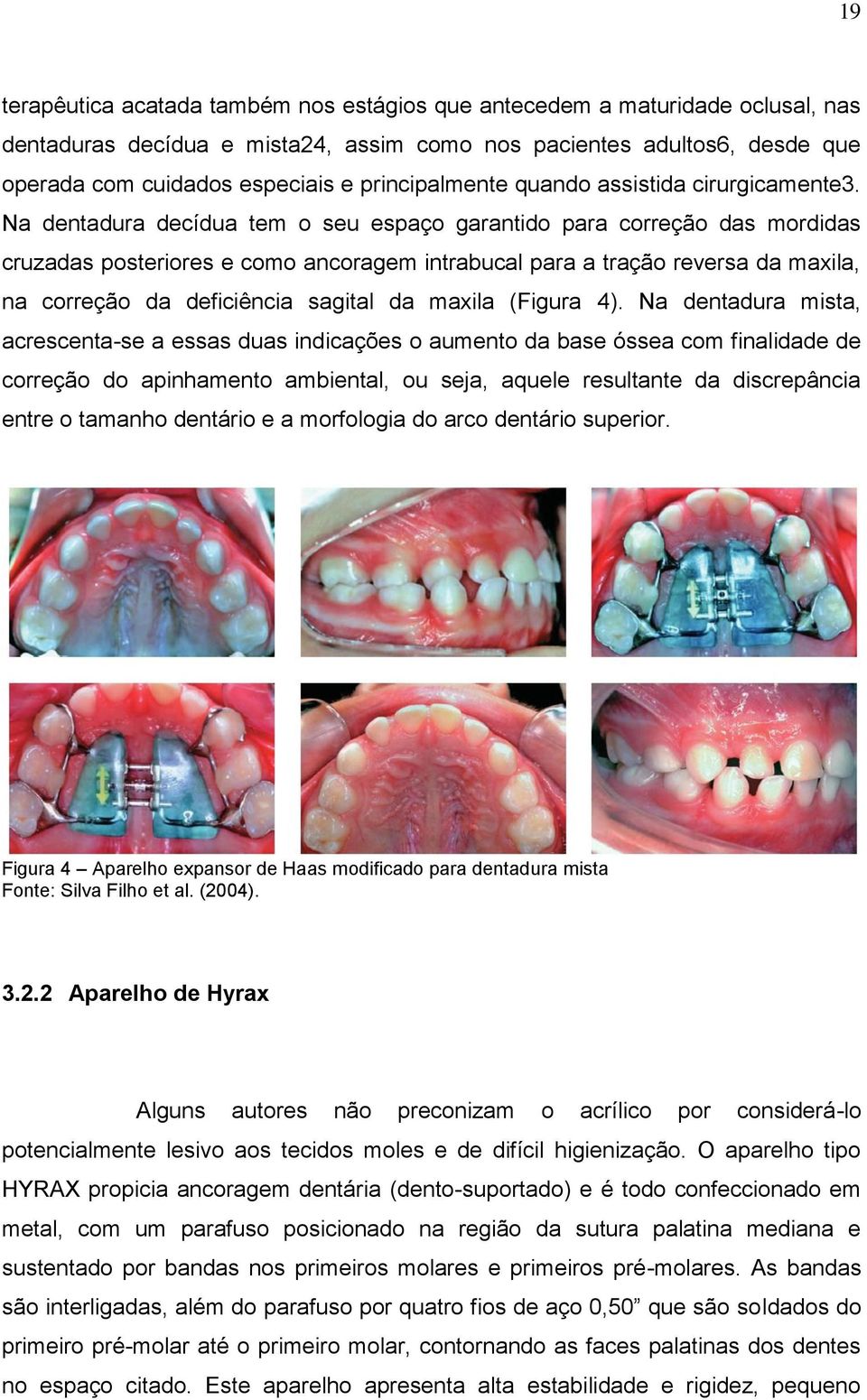 Na dentadura decídua tem o seu espaço garantido para correção das mordidas cruzadas posteriores e como ancoragem intrabucal para a tração reversa da maxila, na correção da deficiência sagital da