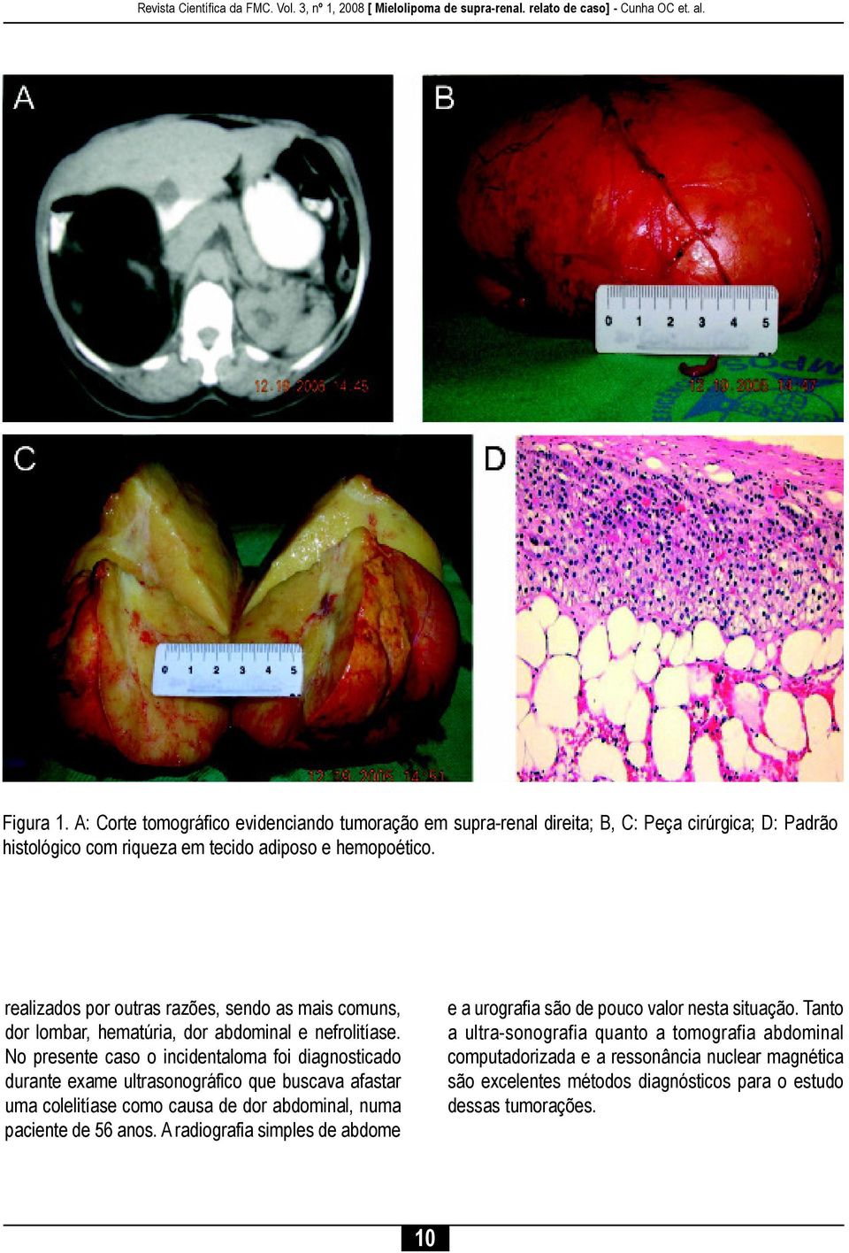 No presente caso o incidentaloma foi diagnosticado durante exame ultrasonográfico que buscava afastar uma colelitíase como causa de dor abdominal, numa paciente de 56 anos.