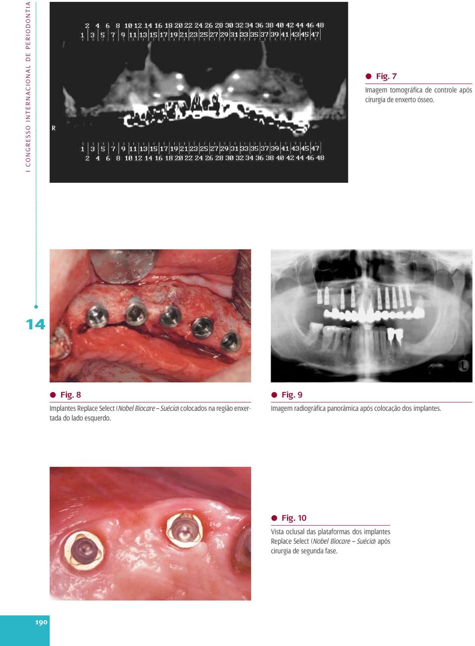 8 Implantes Replace Select (Nobel Biocare Suécia) colocados na região enxertada do lado esquerdo. l Fig.