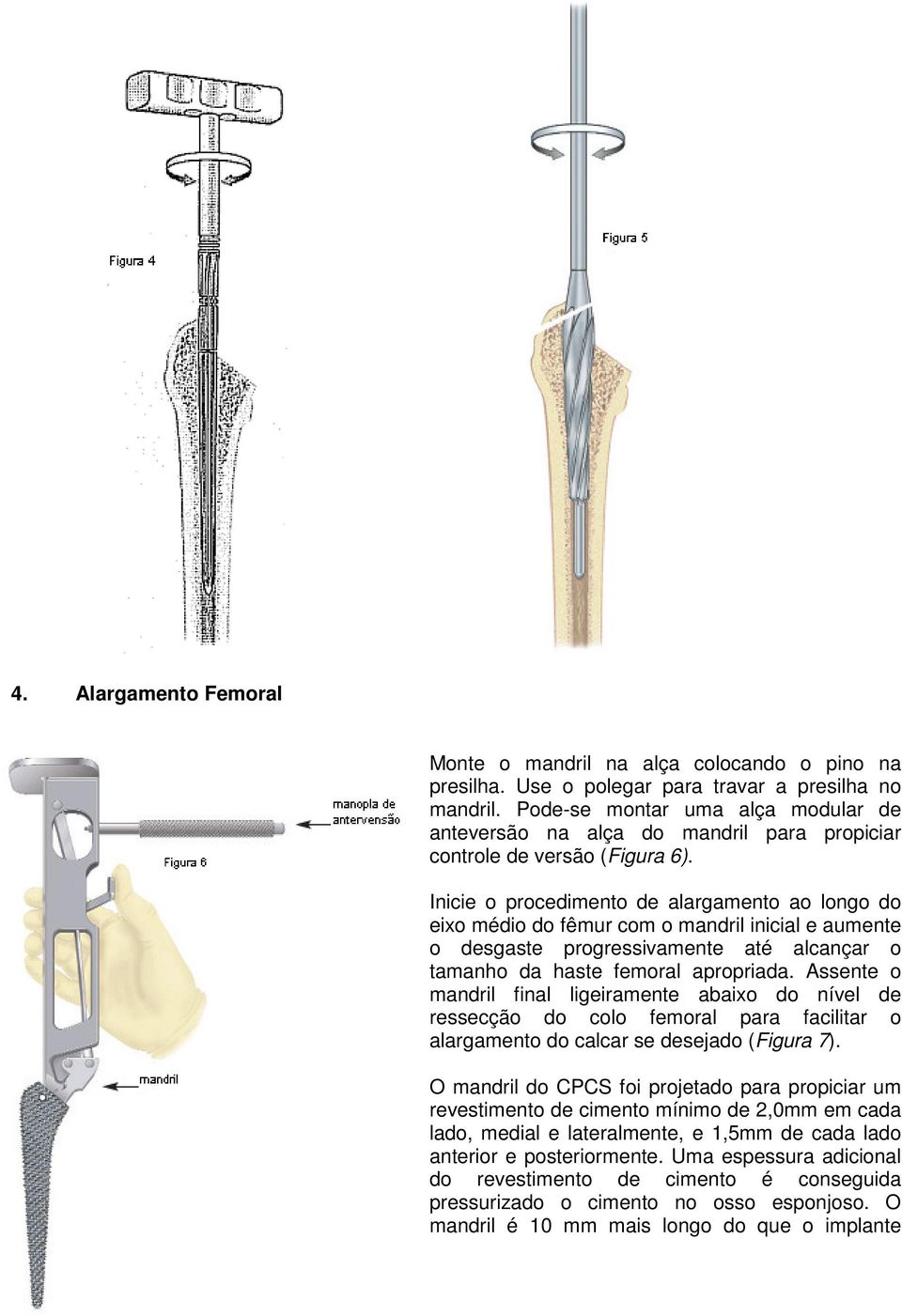 Inicie o procedimento de alargamento ao longo do eixo médio do fêmur com o mandril inicial e aumente o desgaste progressivamente até alcançar o tamanho da haste femoral apropriada.