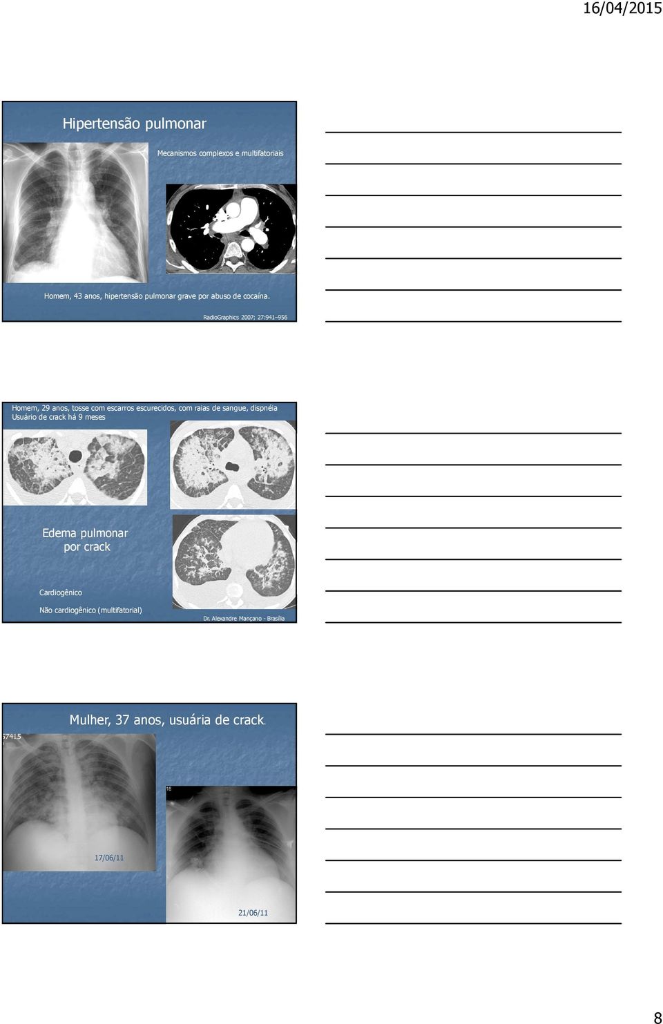 RadioGraphics 2007; 27:941 956 Homem, 29 anos, tosse com escarros escurecidos, com raias de sangue, dispnéia