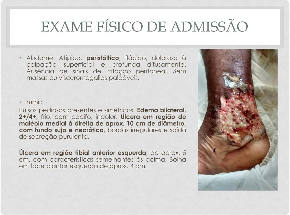 Edema bilateral, 2+/4+, frio, com cacifo, indolor. Úlcera em região de maléolo medial à direita de aprox.