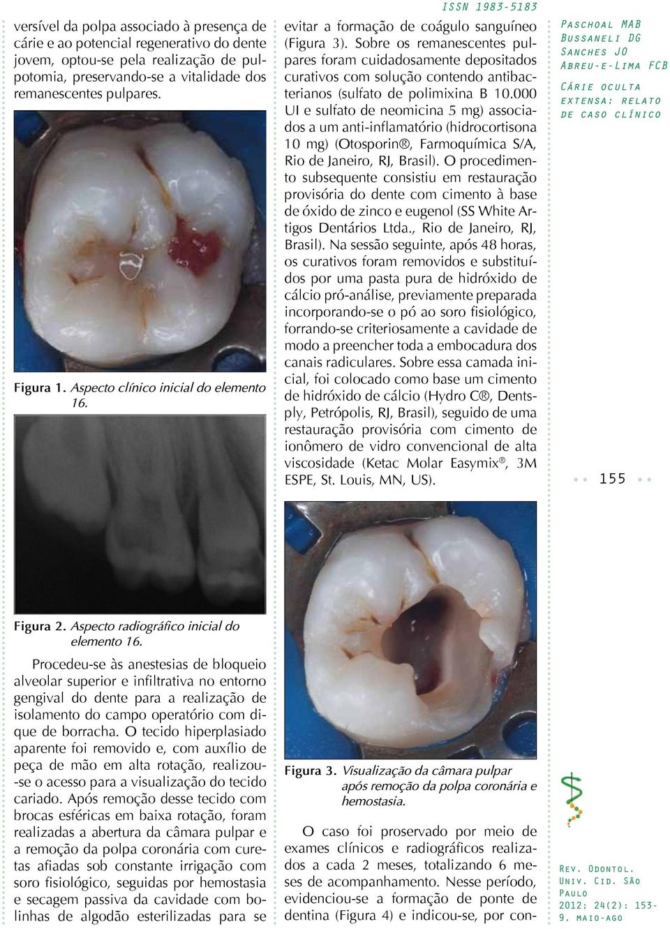 Sobre os remanescentes pulpares foram cuidadosamente depositados curativos com solução contendo antibacterianos (sulfato de polimixina B 10.