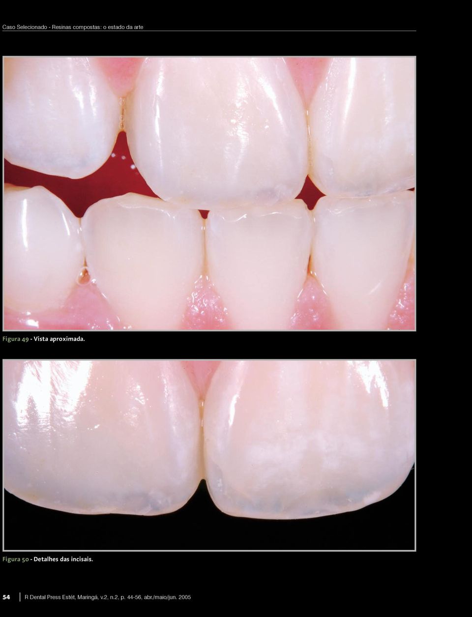 Figura 50 - Detalhes das incisais.