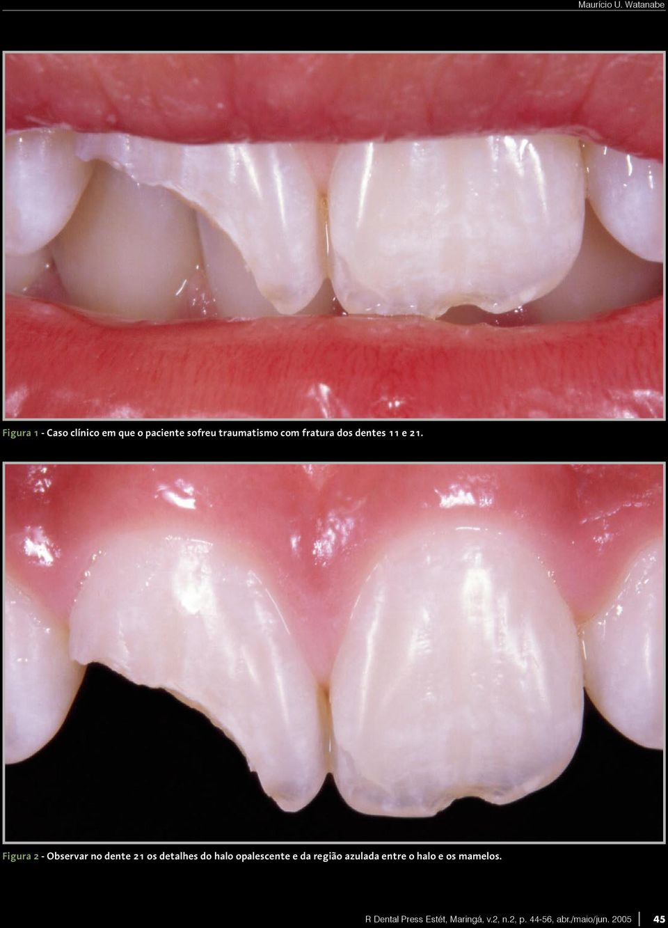 dos dentes 11 e 21.