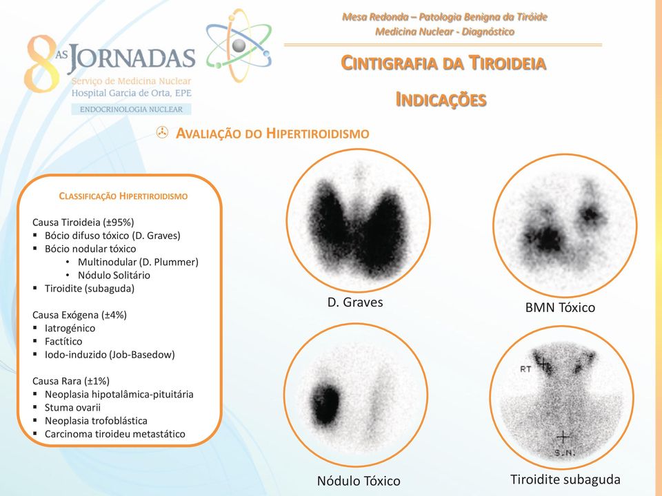 Plummer) Nódulo Solitário Tiroidite (subaguda) Causa Exógena (±4%) Iatrogénico Factítico Iodo-induzido (Job-Basedow) D.