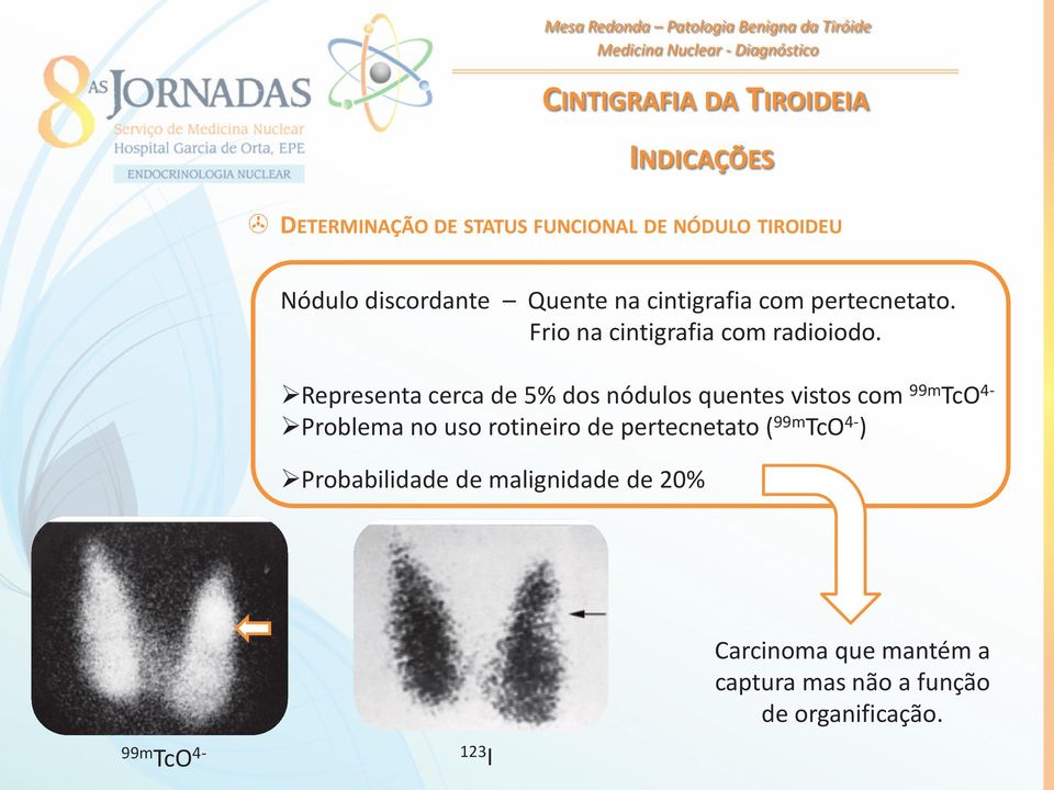 Representa cerca de 5% dos nódulos quentes vistos com 99m TcO 4- Problema no uso rotineiro de