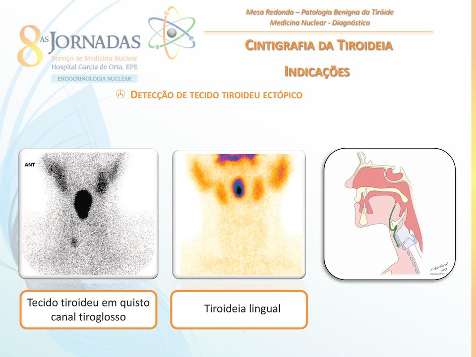 TIROIDEU ECTÓPICO Tecido tiroideu em