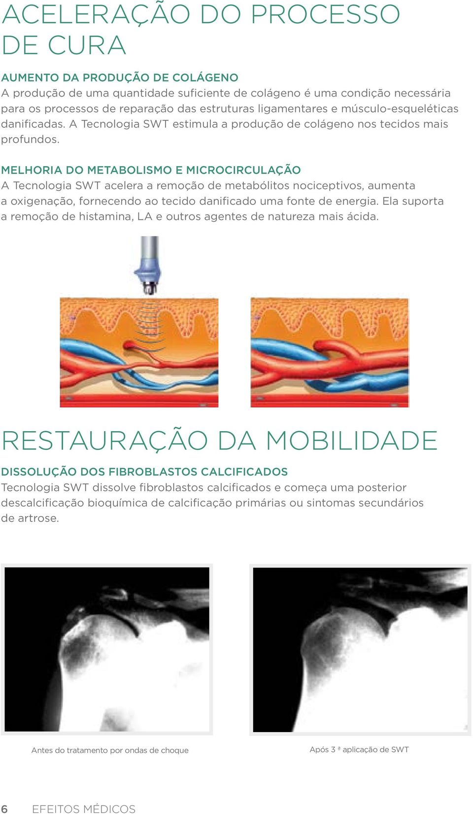 Melhoria do metabolismo e microcirculação A Tecnologia SWT acelera a remoção de metabólitos nociceptivos, aumenta a oxigenação, fornecendo ao tecido danificado uma fonte de energia.