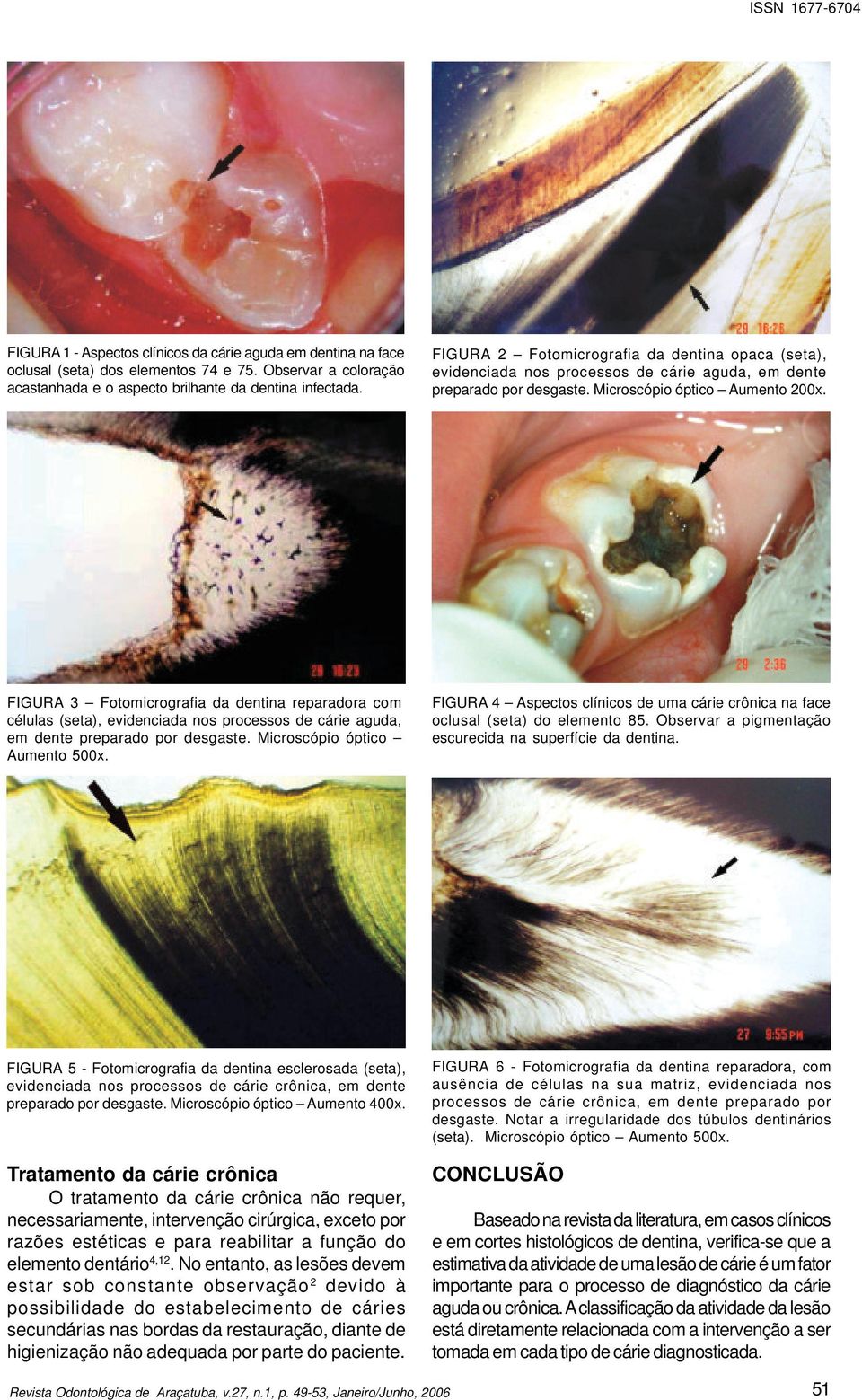 FIGURA 3 Fotomicrografia da dentina reparadora com células (seta), evidenciada nos processos de cárie aguda, em dente preparado por desgaste. Microscópio óptico Aumento 500x.