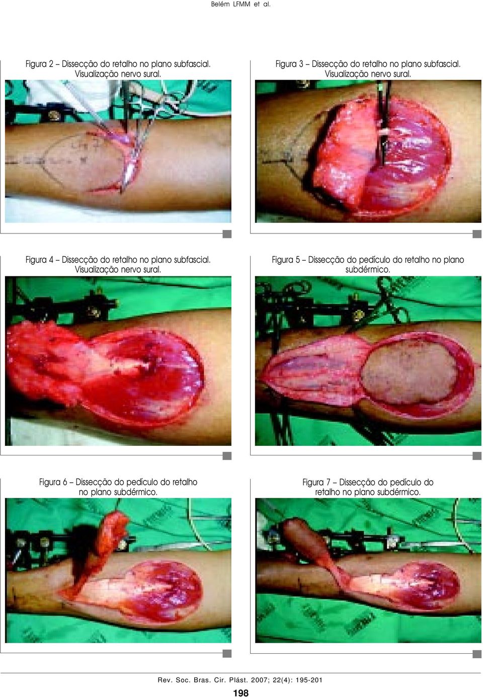 Figura 4 Dissecção do retalho no plano subfascial. Visualização nervo sural.