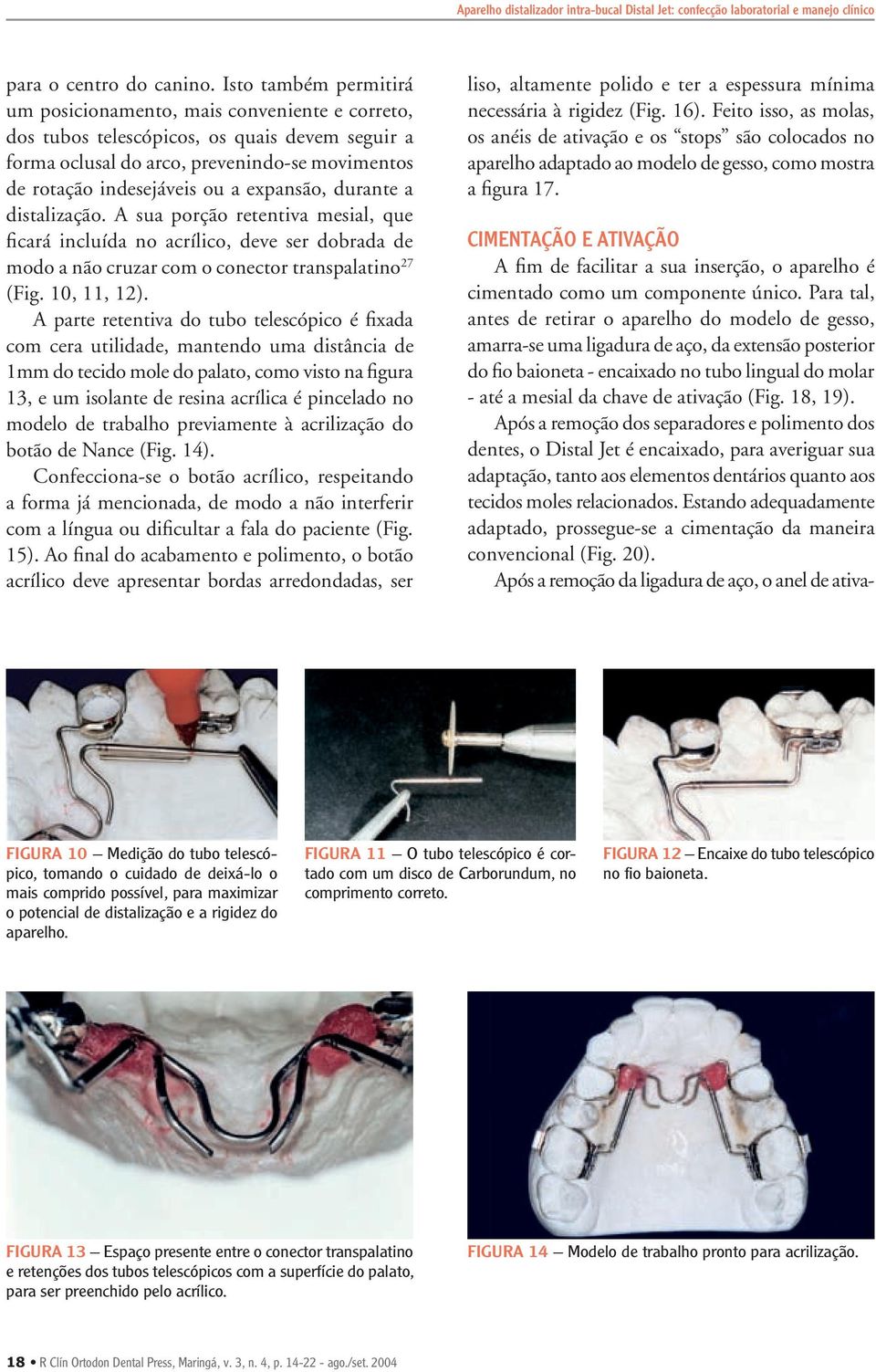 expansão, durante a distalização. A sua porção retentiva mesial, que ficará incluída no acrílico, deve ser dobrada de modo a não cruzar com o conector transpalatino 27 (Fig. 10, 11, 12).