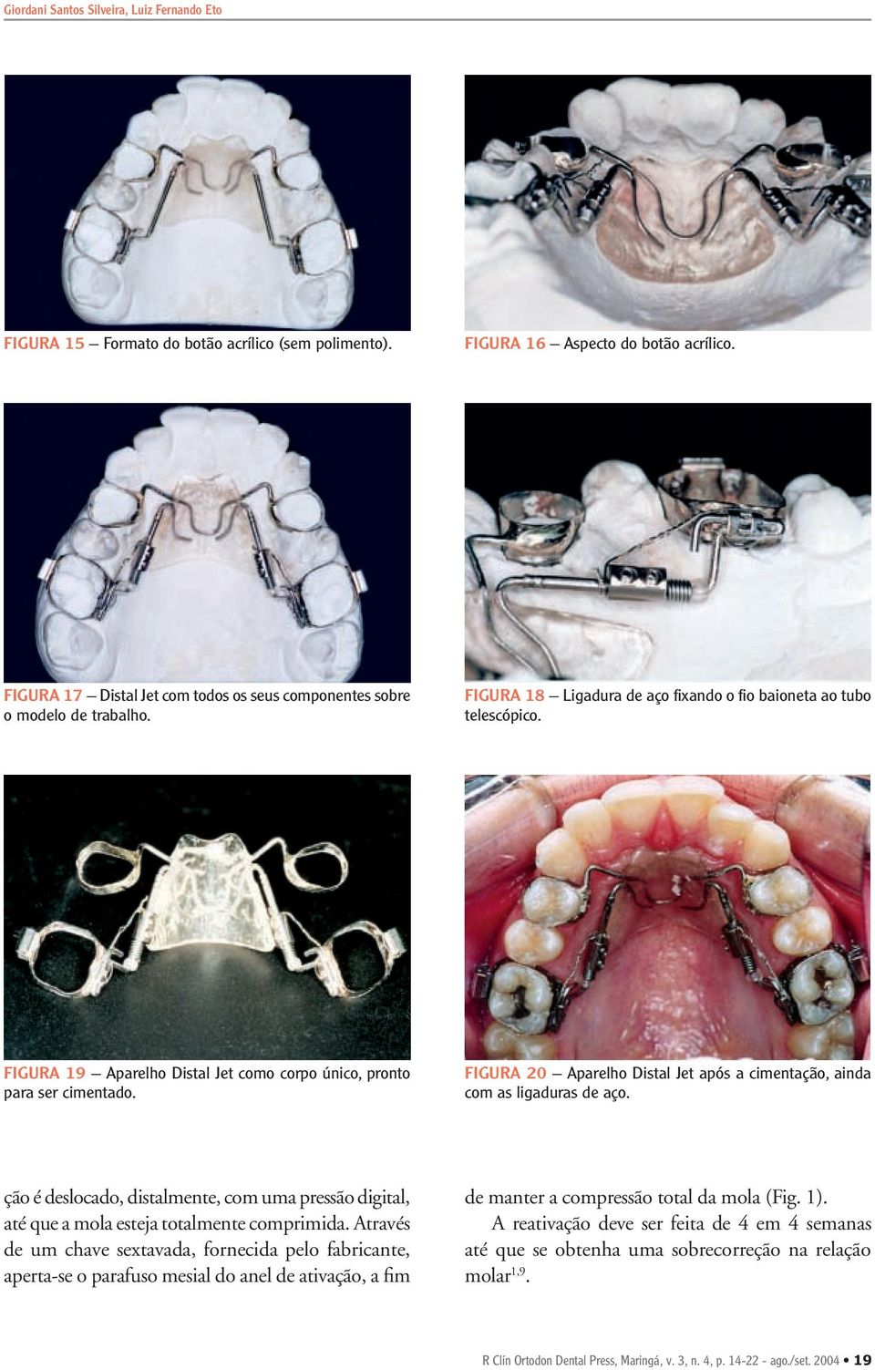 FIGURA 19 Aparelho Distal Jet como corpo único, pronto para ser cimentado. FIGURA 20 Aparelho Distal Jet após a cimentação, ainda com as ligaduras de aço.