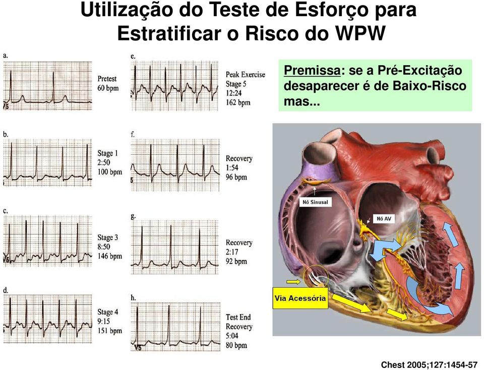 se a Pré-Excitação desaparecer é de