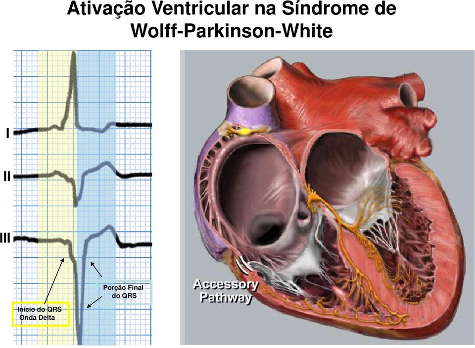 Sinusal Nó AV III Porção Final do