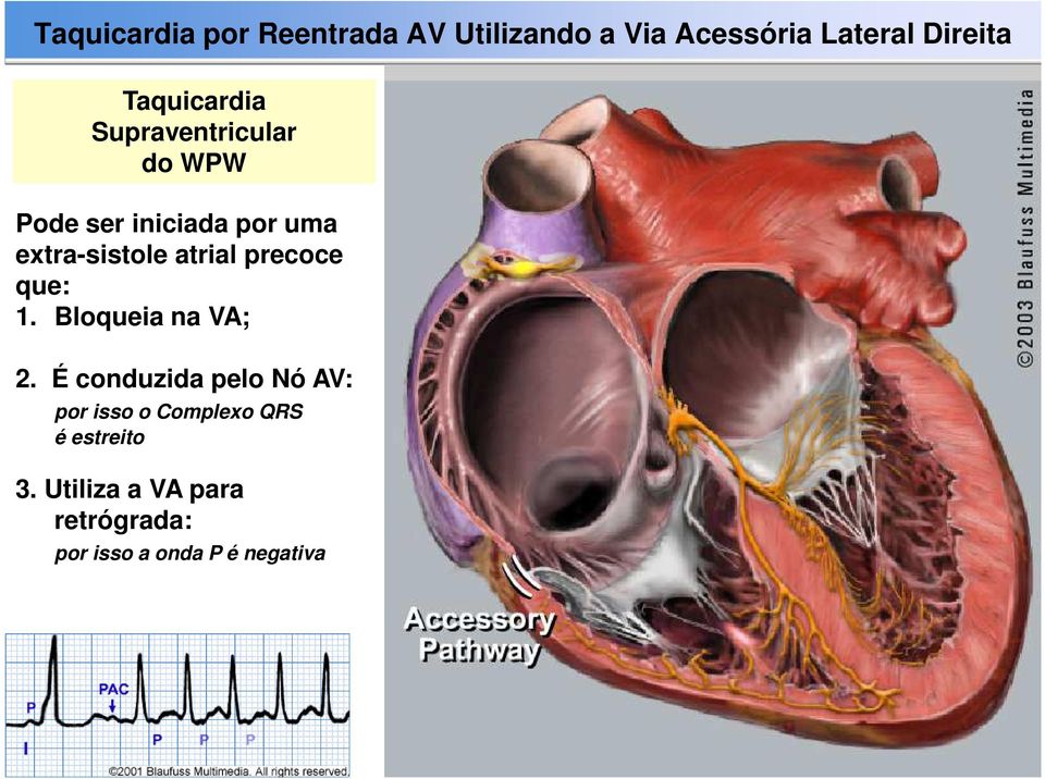 atrial precoce que: 1. Bloqueia na VA; 2.