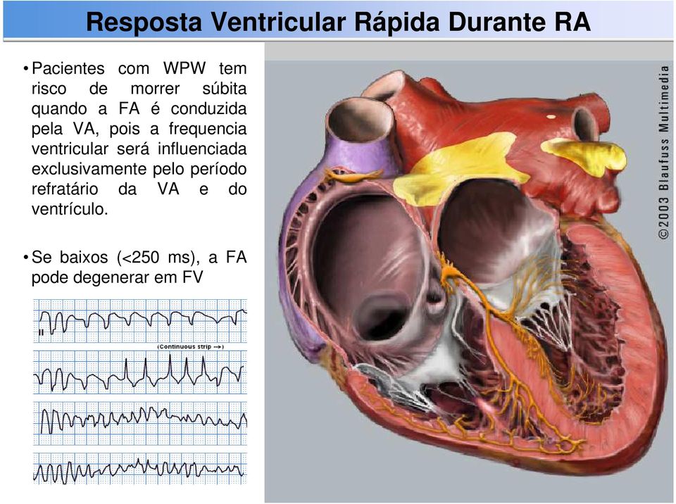 ventricular será influenciada exclusivamente pelo período refratário da VA