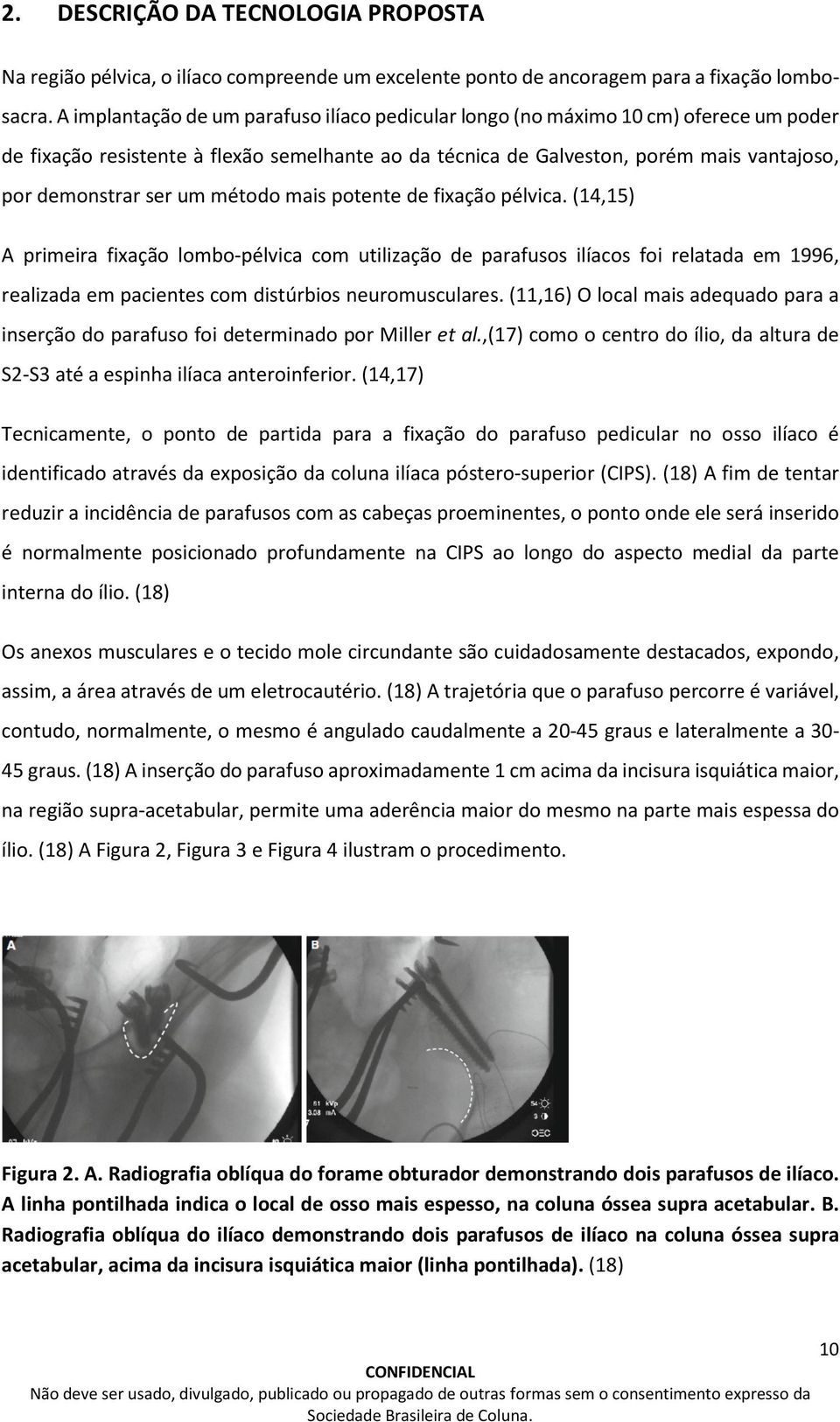 um método mais potente de fixação pélvica. (14,15) A primeira fixação lombo-pélvica com utilização de parafusos ilíacos foi relatada em 1996, realizada em pacientes com distúrbios neuromusculares.