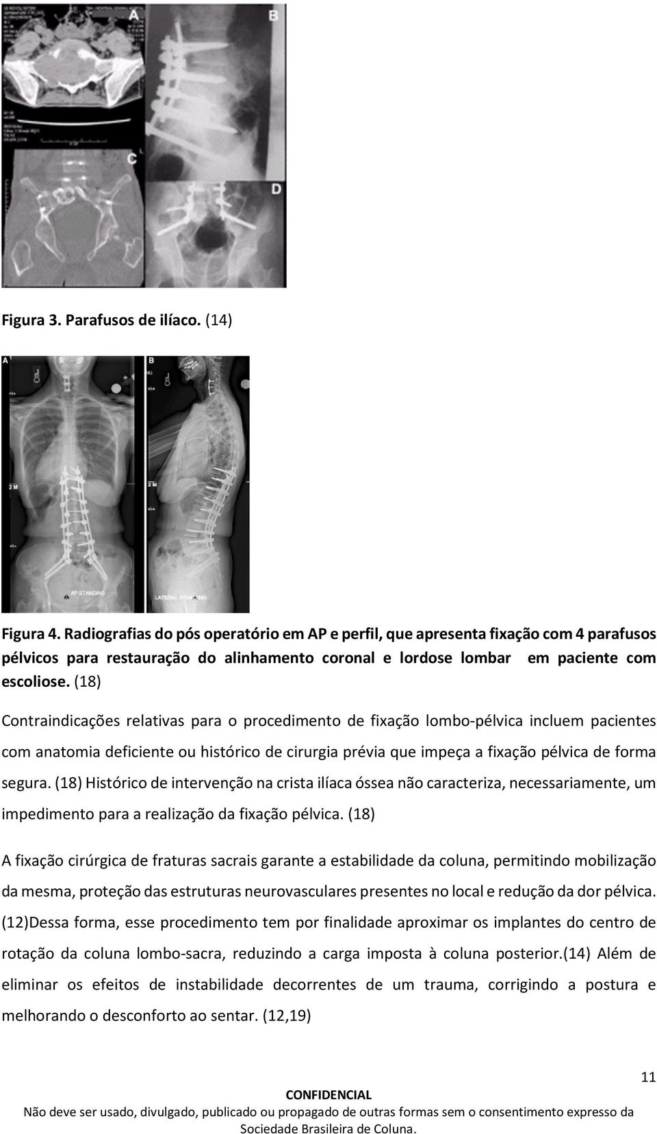 (18) Contraindicações relativas para o procedimento de fixação lombo-pélvica incluem pacientes com anatomia deficiente ou histórico de cirurgia prévia que impeça a fixação pélvica de forma segura.